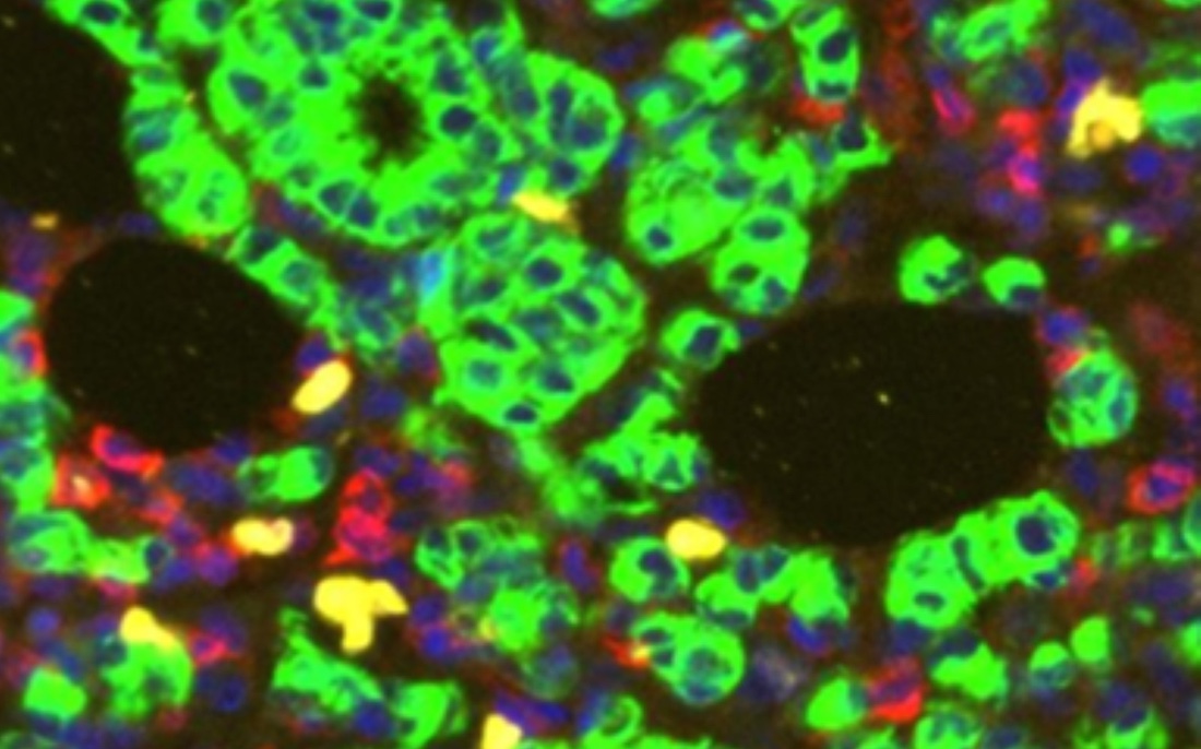 Breast cancers treated with estrogen-depriving therapy